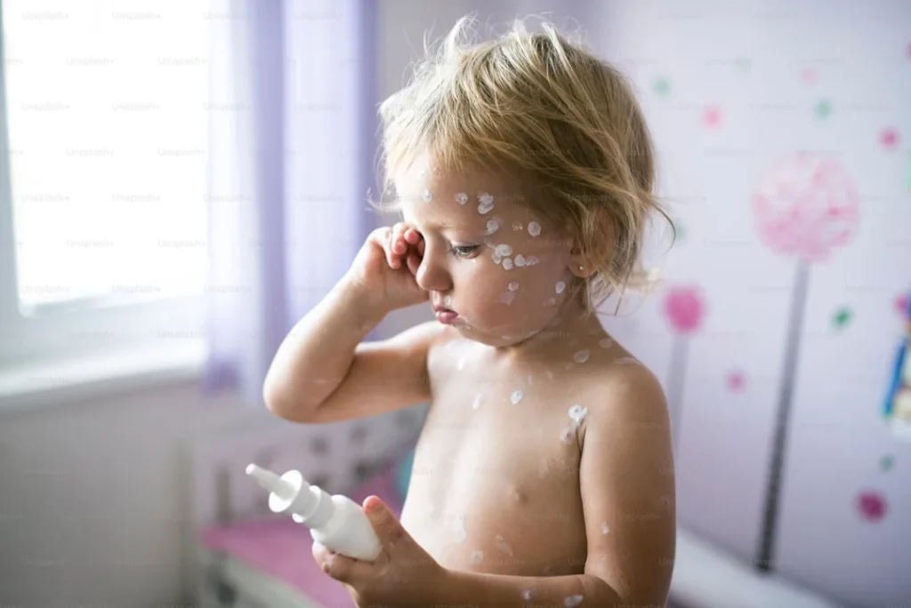 Điều trị rôm sảy ở trẻ em như thế nào?